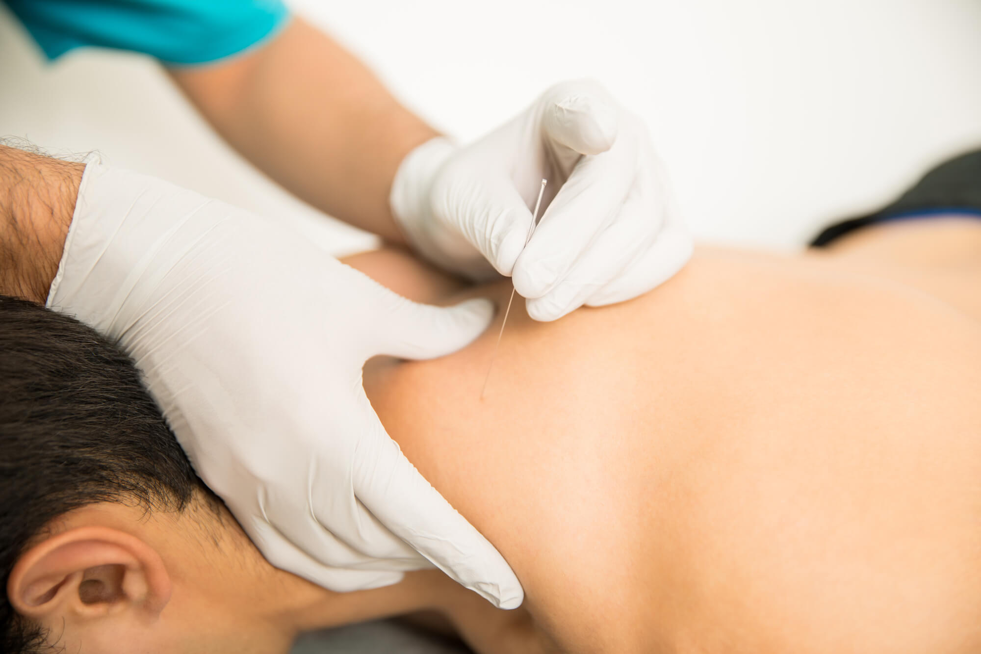 Dry needling bij Fysiopraktijk Zeist